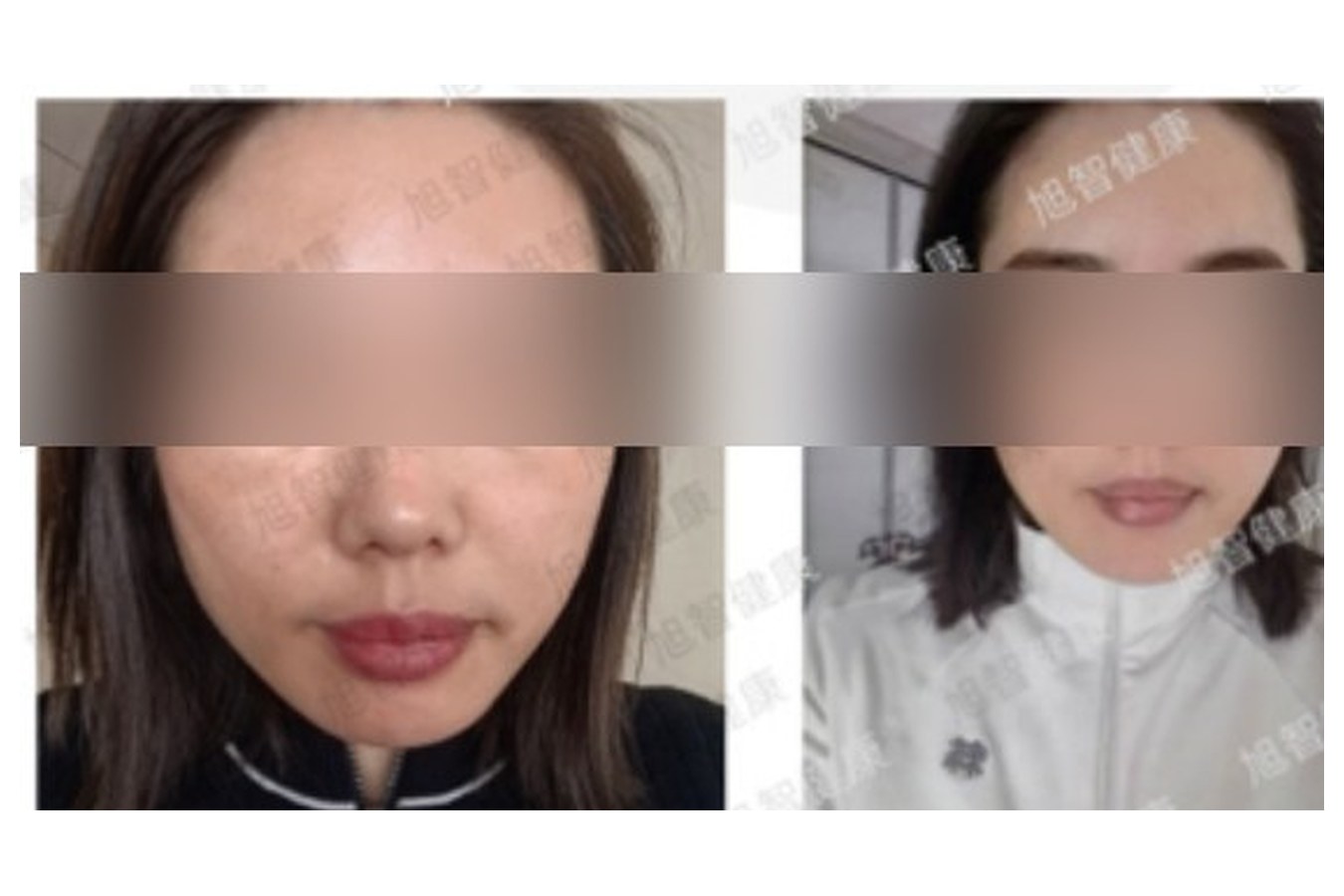 Case 04 comparison, anonymized